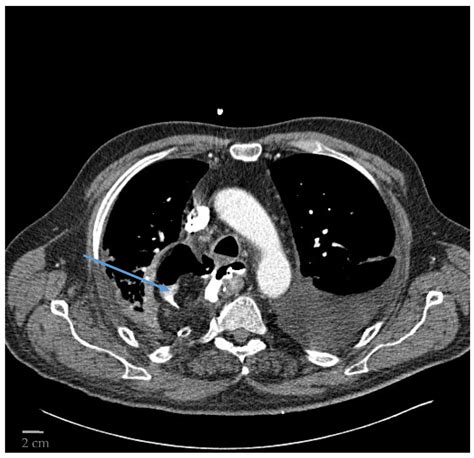 Anastomotic Leakage After Oesophagectomy Upper Endoscopy Or Computed