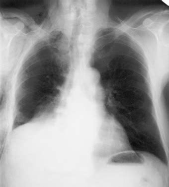 Paracardiac Opacity Following Inferior And Middle Lobe Resection For