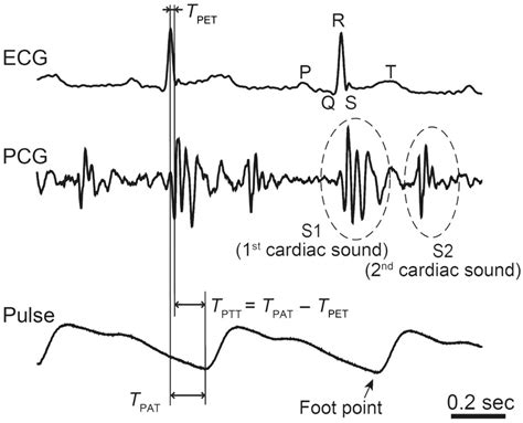 Method Of Pulse Wave Transit Time Pulse Wave Transit Time T Pt T Is