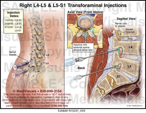 L4 L5 And L5 S1 Transforaminal Injections