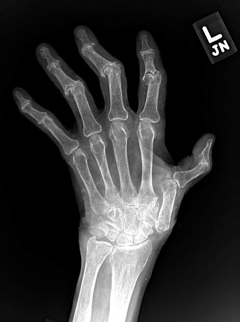 erosive osteoarthritis | pacs