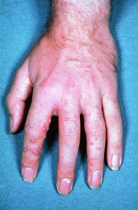 Shingles Rash On Hand Photograph by James Stevenson/science Photo ...