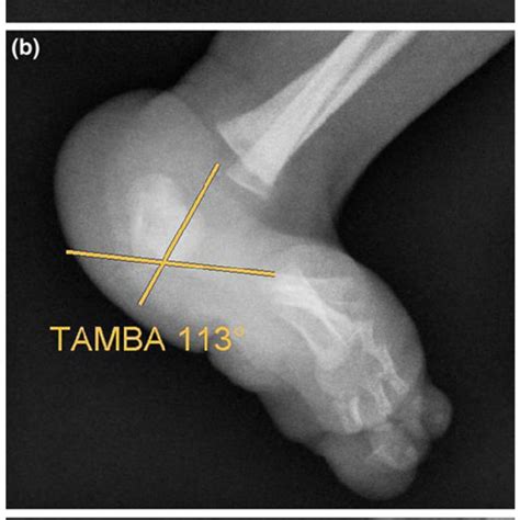 Clinical Appearance Of A Severe Congenital Vertical Talus CVT