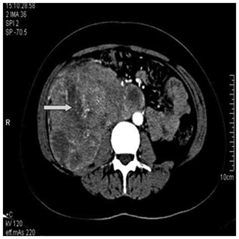 Malignant Renal Epithelioid Angiomyolipoma A Case Report And Review Of