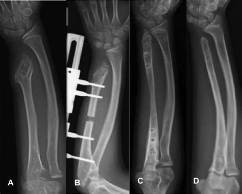 A Illustration Of Case 2 At Preoperative Period B Illustration Of Download Scientific