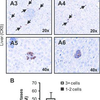 Klf Overexpression Decreases Lung And Liver Micrometastases A