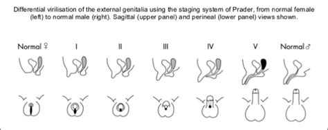 Disorders Of Sex DevelopmentAmbiguous Genitalia Journal Of Pediatric