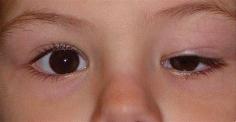 Ptosis Signs And Symptoms Discover What They Are