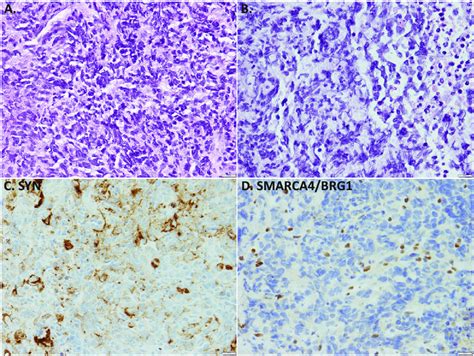 Thoracic Smarca4 Deficient Undifferentiated Tumor As A Mimicker Of Download Scientific Diagram