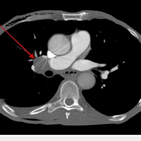 Computed Tomography Ct Chest Showing Right Hilar Lymphadenopathy Download Scientific Diagram