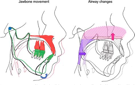 Figure 1 From Computational Fluid Dynamic Analysis Of The Nasal