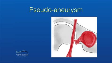 Endovascular Treatment of a Femoral Pseudo-aneurysm - YouTube