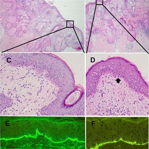 Pathological Pictures Of The Skin Lesion A And B Show The