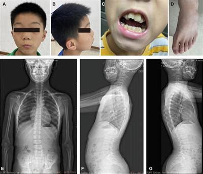 Frontiers Case Report Identification Of A Novel Prr Variant In A