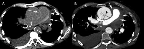 Case Series Pulmonary Artery Intramural Hematoma In Stanford Type A