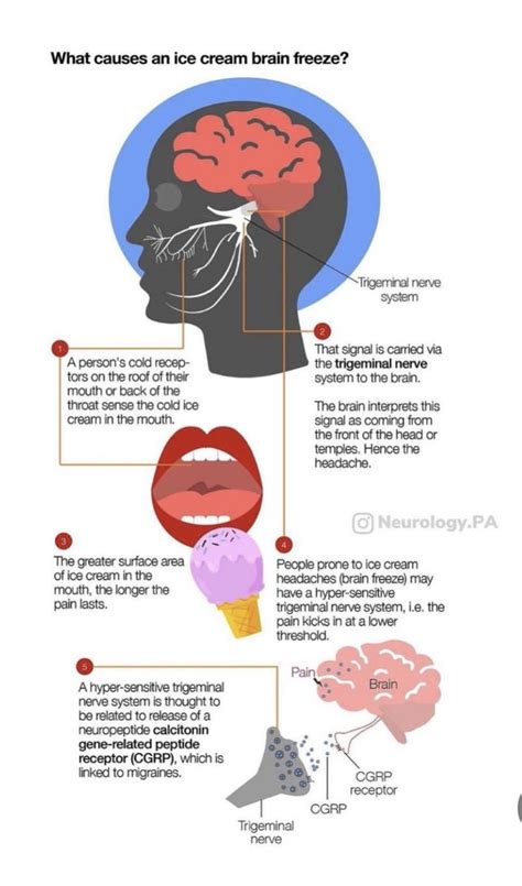 Oren Gottfried Md On Twitter Ice Cream Brain Freeze Headaches