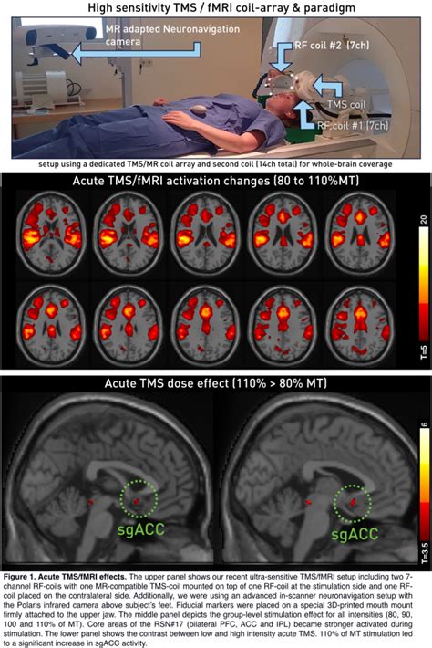 Concurrent Tms Fmri Demonstrates Direct Sgacc Target Engagement Fmri