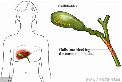 得了膽結石怎麼治療，是否需要手術？消化內科李醫生告訴你答案 每日頭條