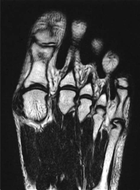 Figure From Tumoral Calcinosis Of The Foot Mri Histologic