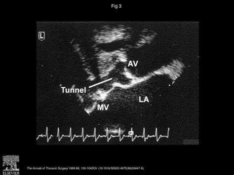 Fixed Left Ventricular Outflow Tract Obstruction In Presumed