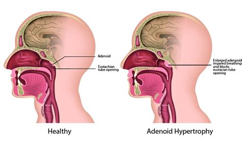 Adenoidectomy - Century ENT