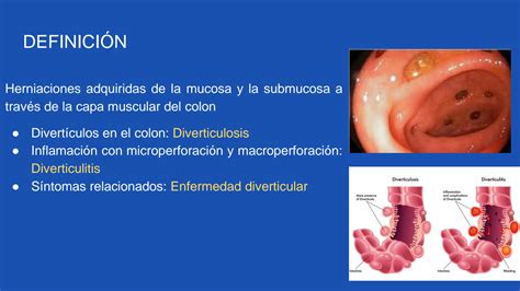 Solution Enfermedad Diverticular Del Colon Studypool