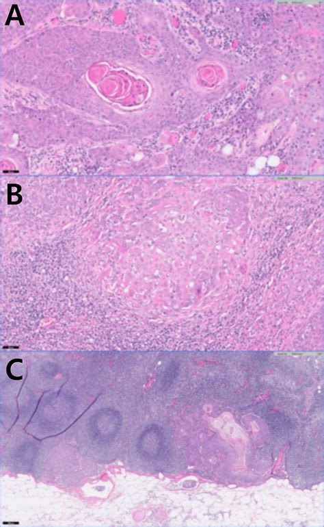 Frontiers Case Report Evaluation Of Cutaneous Squamous Cell Carcinoma Metastasized To Lymph