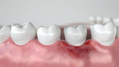 Tratamiento de la gingivitis causas cuidados y síntomas Estudi