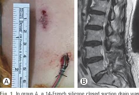 Lumbar Discectomy Scar