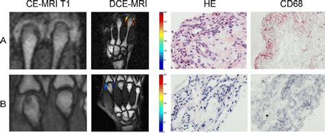 Contrast Enhanced T1 Weighted Magnetic Resonance Imaging Of