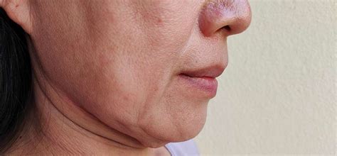 Nefertiti Lift Sagging Neck And Jawline Treatment Mh Clinics