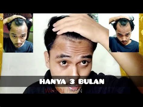 Cara Menumbuhkan Rambut Botak Samping Atau Botak M Atau Botak Bejita