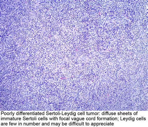 Pathology Outlines Sertoli Leydig Cell Tumor