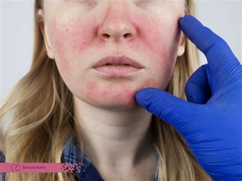 Rosacea Nose