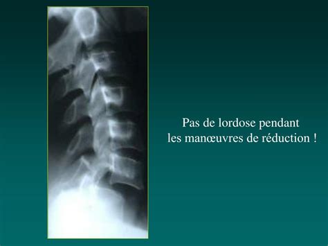 Ppt Evaluation Clinique Et Radiologique Dun Bless Rachi M Dullaire