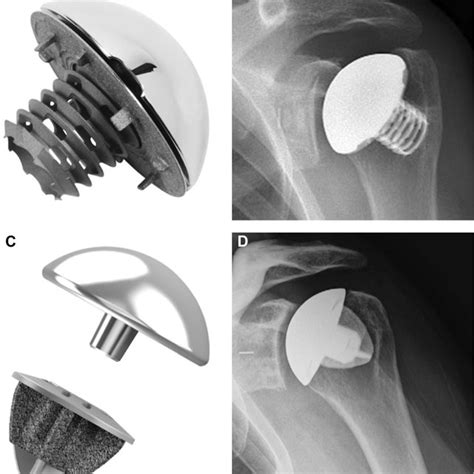 Pdf Stemless Shoulder Arthroplasty Review Of Short And Medium Term
