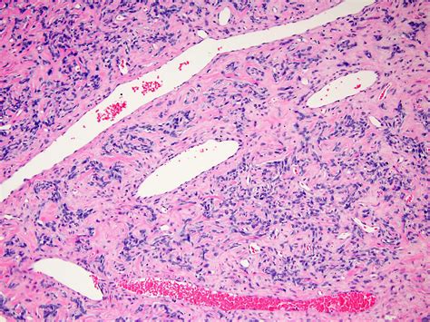 Pathology Outlines Who Classification