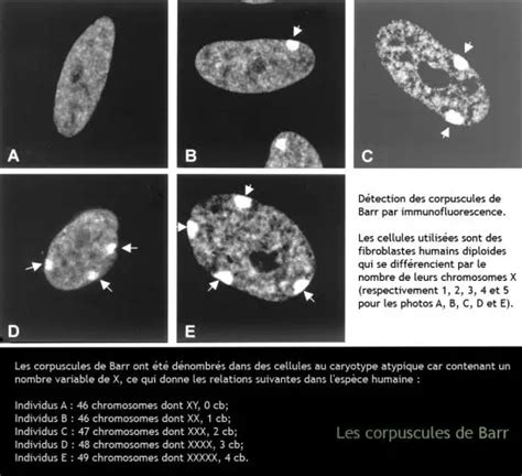 Corpuscule De Barr Dr KARA ZAITRI M A