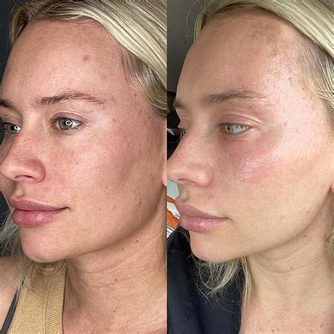 Laser Skin Resurfacing Pmu Central