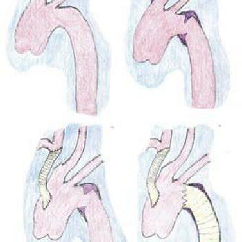 ( A ) “Normal aortic arch” anatomy, ( B ) “Bovine aortic arch,” ( C ...