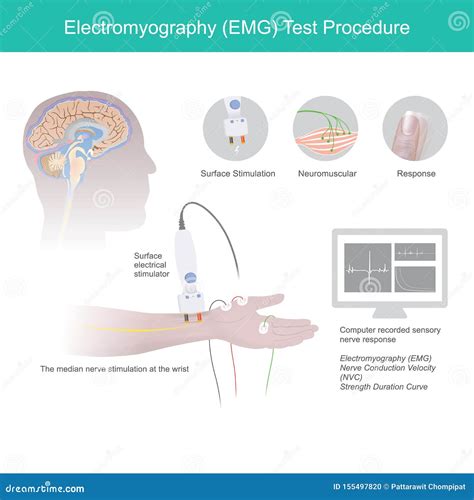 Electromyography Test Procedure. EMG Vector Illustration | CartoonDealer.com #155497820