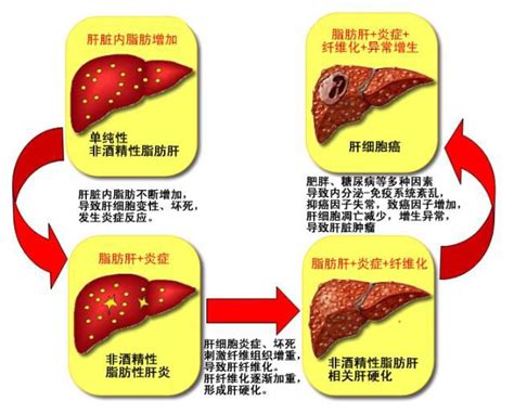 非酒精性脂肪肝炎模型代谢肝脏疾病凯斯艾生物科技（苏州）有限公司