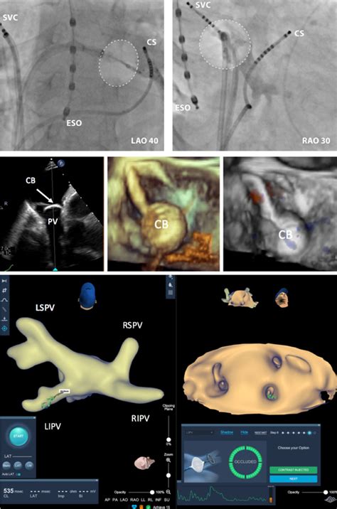 Wide Band Dielectric Imaging And The Novel Cryoballoon Occlusion Tool To Guide Cryoballoon Based