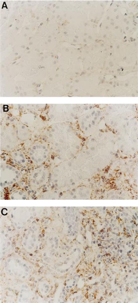 Figure 2 From Nephrology Dialysis Transplantation Enhanced Interstitial