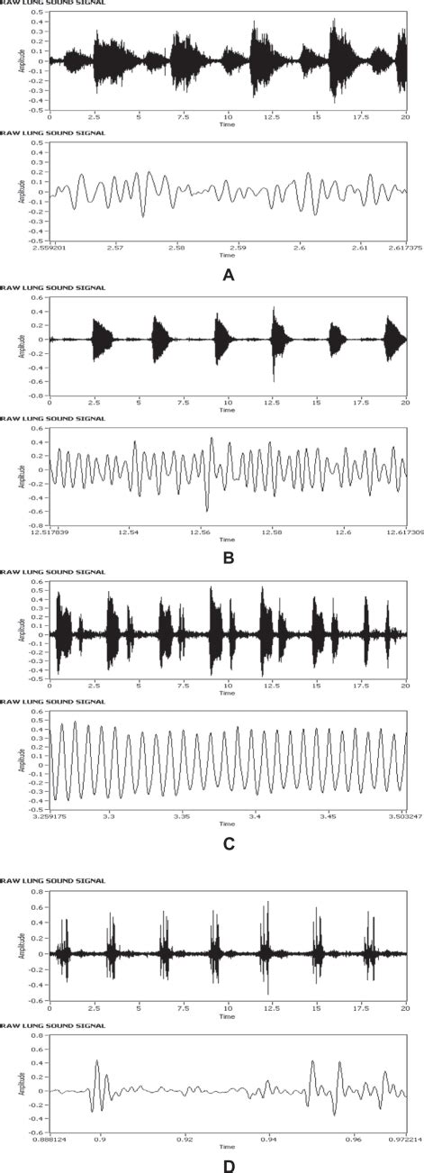 Time Domain Plots Of Lung Sounds Seen In Both The Time Unexpanded And