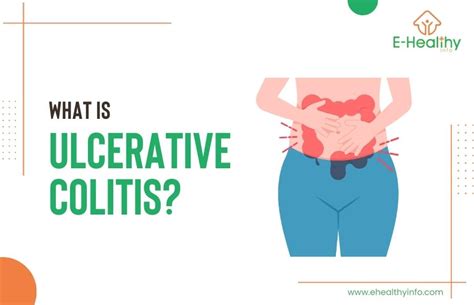 Ulcerative Colitis - Symptoms, Causes, Treatment, and More