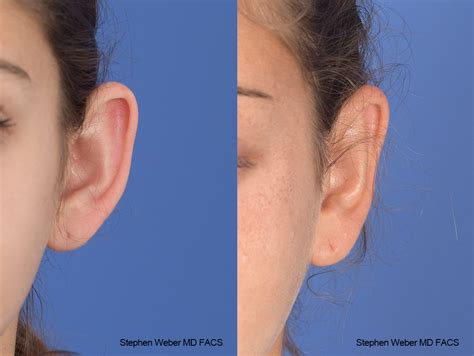 Otoplasty Before And After 46 Weber Facial Plastic Surgery