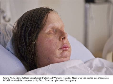 Woman Who Had Face Transplant Following Chimp Attack Opens Up In