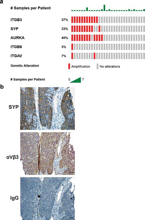 Upregulation Of αvβ3 Integrin In Neprca Patients A Bioinformatic