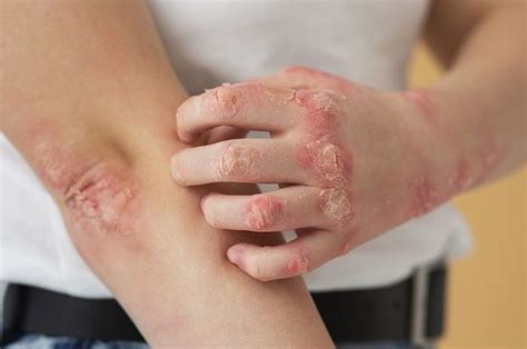 Penyakit Kulit Psoriasis Apakah Menular Ini Penjelasan Dokter Kulit